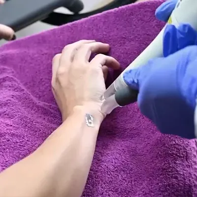 img-borrar-tatuajes-medellin -1-LCP