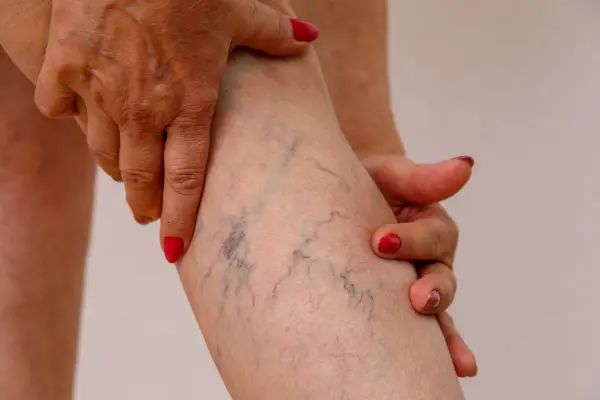 ¿Sientes molestias que afectan tu día a día por el dolor en las venas varices? Comprender qué hacer para el dolor de venas varices es fundamental para encontrar alivio y...