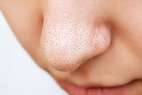 ¿Quieres saber cómo quitar los puntos negros de la nariz y mejorar la apariencia de tu piel? En este artículo de Derma Skin Care te explicamos qué son, por qué...