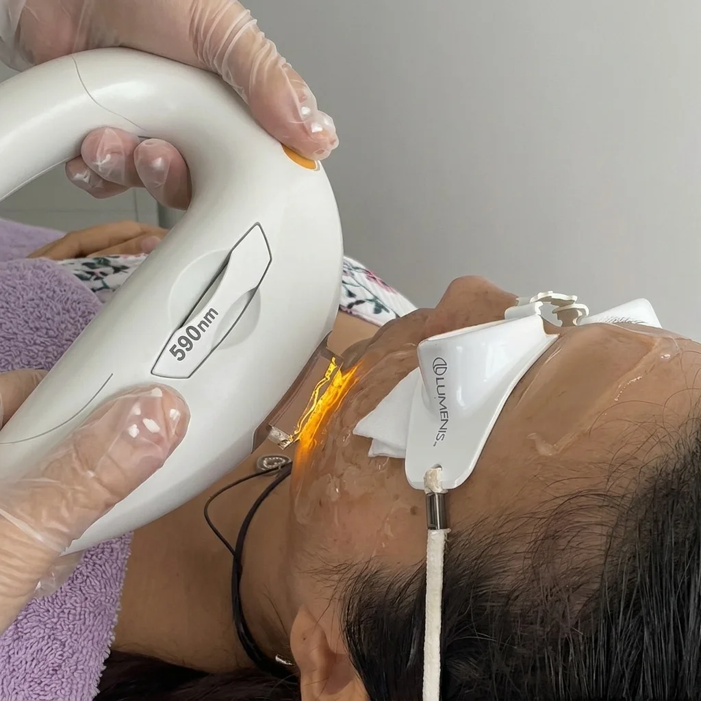 Fotorejuvenecimiento con IPL M22 en Dermaskincare