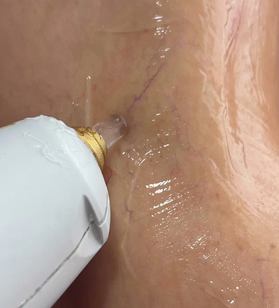 Tratamiento con láser vascular M22 Nd:YAG en Dermaskincare