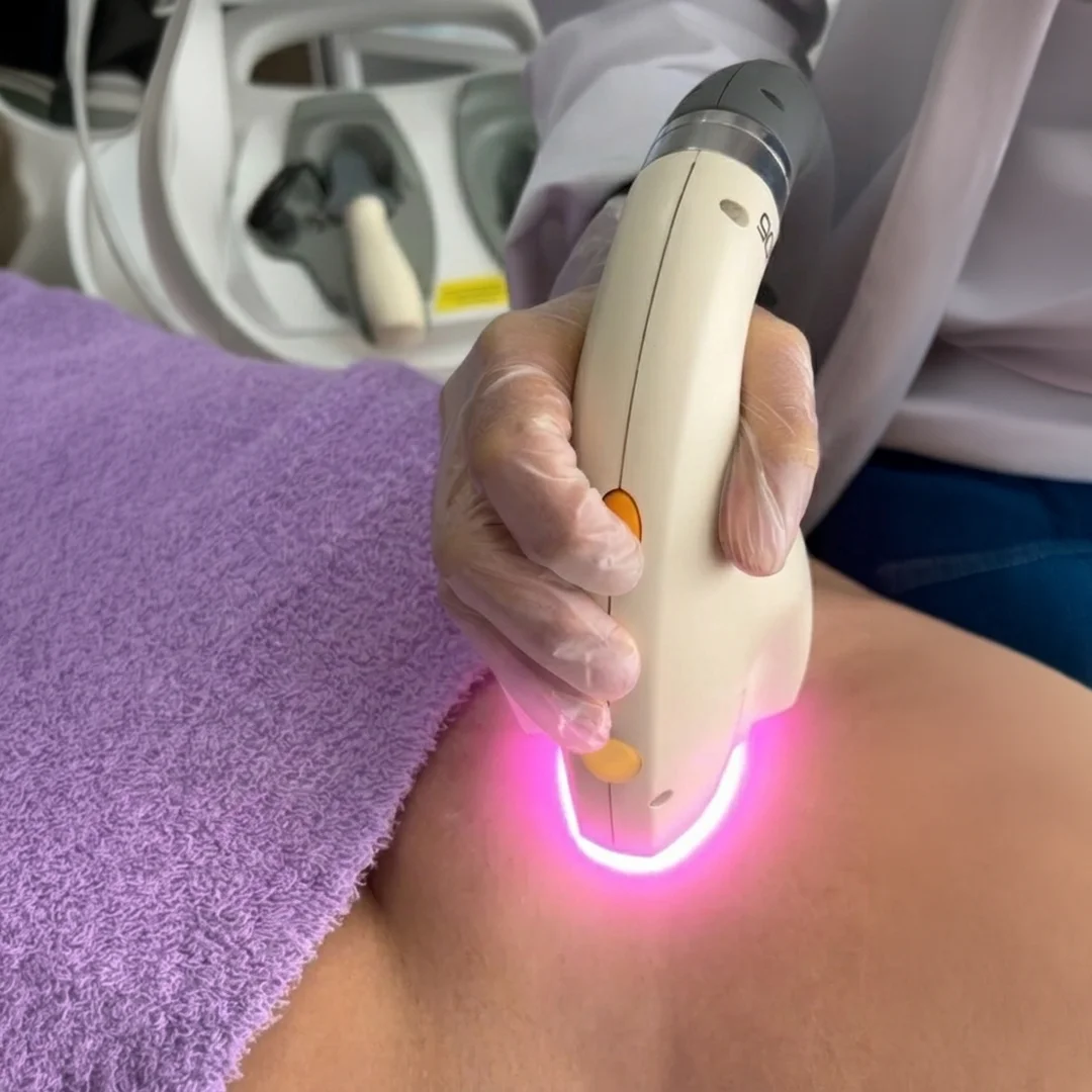 Depilación láser Fénix EV en Dermaskincare